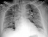 covid-19-pneumonia-12.jpg