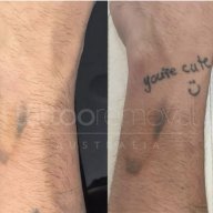 tattoo removal brisbane